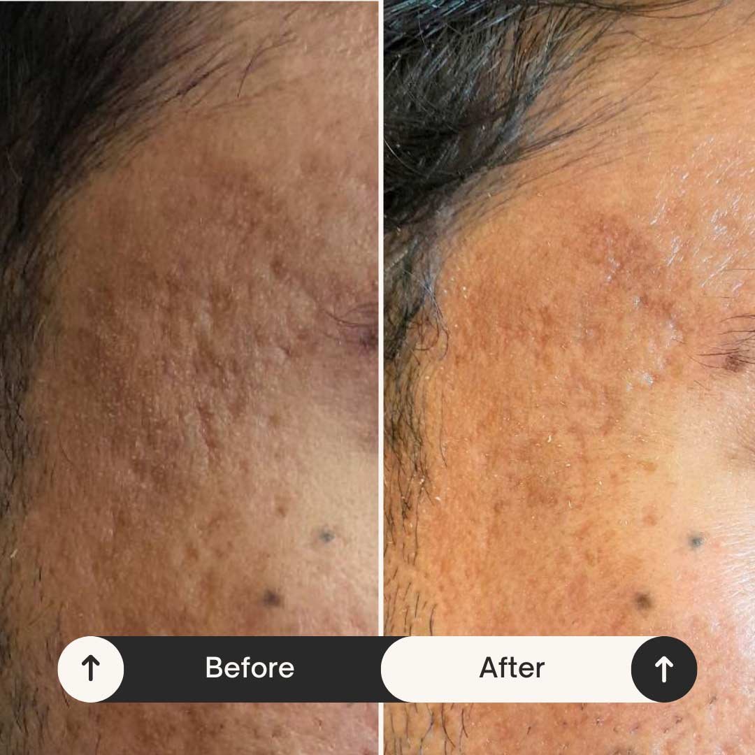 Beige Minimalist Skincare Before and After Instagram Post_20250621_131209_0000