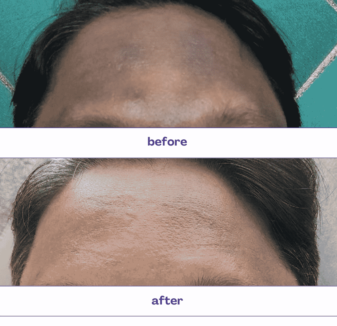 Purple and White Minimalist Corporate Dental Care Before After Instagram Po_20250619_212846_0000-min